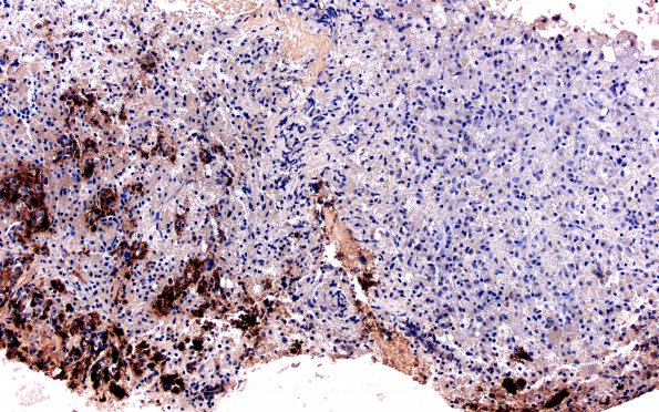 2D Hypophysitis, xanthomatous (Case 2 Chromogranin 2