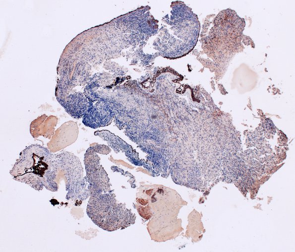 2E1 Hypophysitis, xanthomatous (Case 2) CK 3