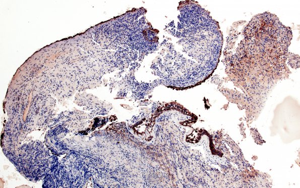 2E2 Hypophysitis, xanthomatous (Case 2) CK 2