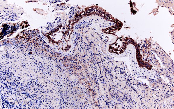 2E3 Hypophysitis, xanthomatous (Case 2) CK 1