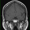 1A1 Idiopathic Hypertrophic Pachymeningitis (hyper-IgG4, Case 1) T1 without contrast copy - Copy