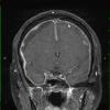 1A2 Idiopathic Hypertrophic Pachymeningitis (hyper-IgG4, Case 1) T1 with contrast - Copy (2)