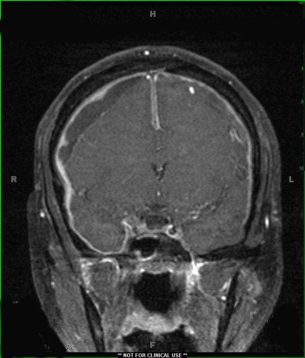 1A2 Idiopathic Hypertrophic Pachymeningitis (hyper-IgG4, Case 1) T1 with contrast - Copy (2)
