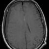 1A3 Idiopathic Hypertrophic Pachymeningitis (hyper-IgG4, Case 1) T1 without contrast - Copy