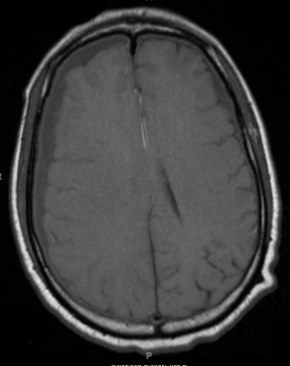 1A3 Idiopathic Hypertrophic Pachymeningitis (hyper-IgG4, Case 1) T1 without contrast - Copy