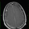 1A4 Idiopathic Hypertrophic Pachymeningitis (hyper-IgG4, Case 1) T1 with contrast - Copy