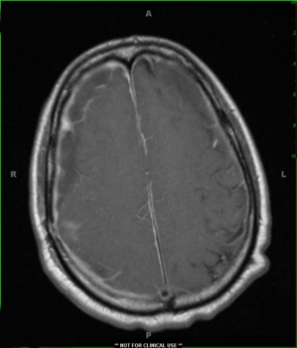 1A4 Idiopathic Hypertrophic Pachymeningitis (hyper-IgG4, Case 1) T1 with contrast - Copy