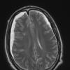 1A5 Idiopathic Hypertrophic Pachymeningitis (hyper-IgG4, Case 1) T2 without contrast - Copy