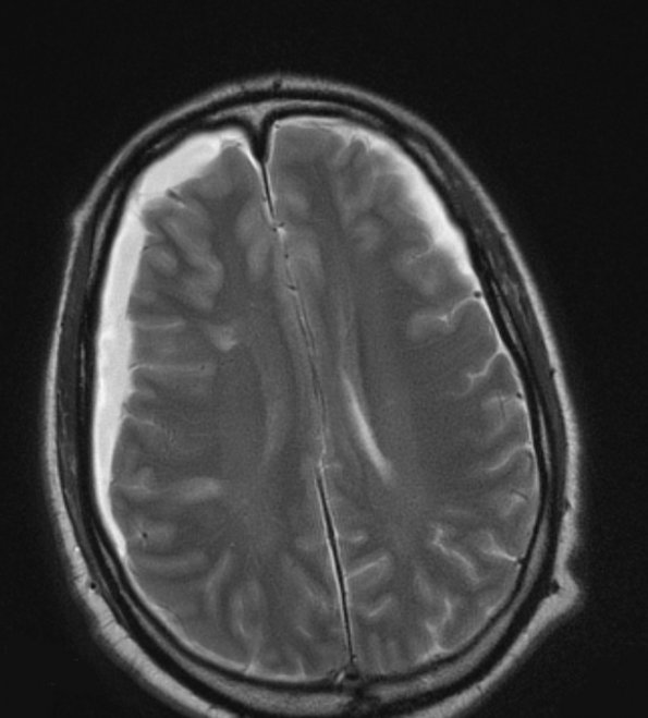 1A5 Idiopathic Hypertrophic Pachymeningitis (hyper-IgG4, Case 1) T2 without contrast - Copy