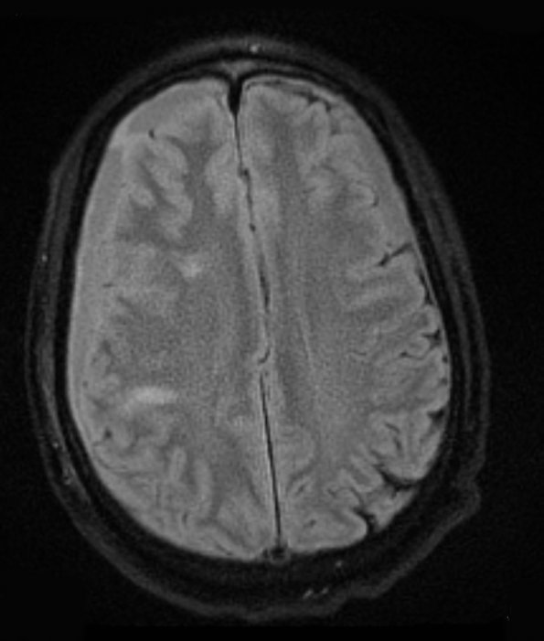 1A6 Idiopathic Hypertrophic Pachymeningitis (hyper-IgG4, Case 1) FLAIR - Copy