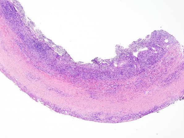 1B1 Idiopathic Hypertrophic Pachymeningitis (hyper-IgG4, Case 1) dura H&E 13