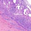 1B2 Idiopathic Hypertrophic Pachymeningitis (hyper-IgG4, Case 1) dura H&E 5