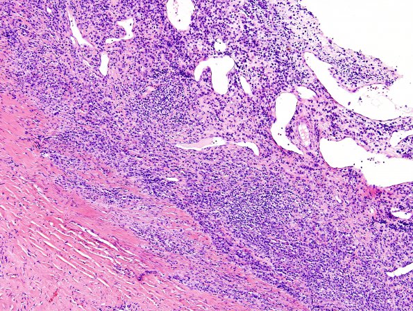 1B2 Idiopathic Hypertrophic Pachymeningitis (hyper-IgG4, Case 1) dura H&E 5