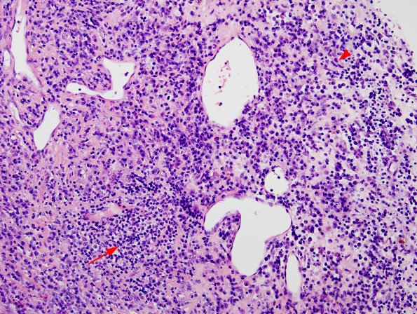 1B3 Idiopathic Hypertrophic Pachymeningitis (hyper-IgG4, Case 1) dura H&E 8 copy