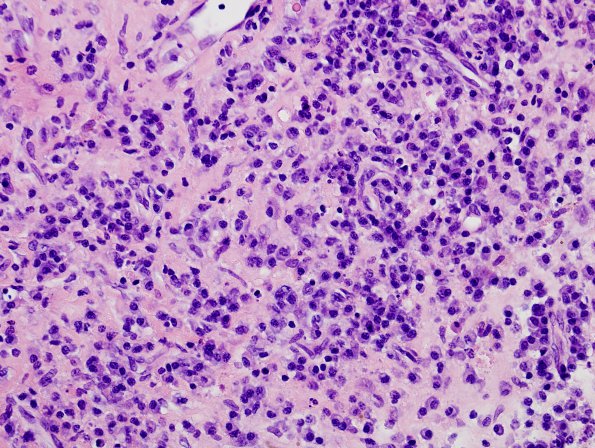 1B4 Idiopathic Hypertrophic Pachymeningitis (hyper-IgG4, Case 1) dura H&E 2