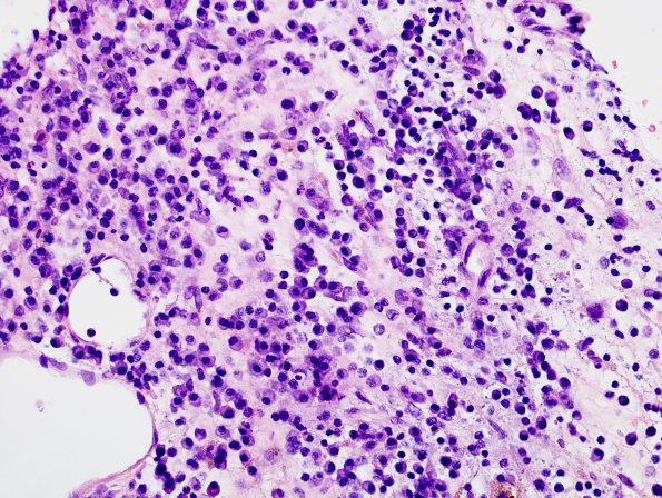 1B5 Idiopathic Hypertrophic Pachymeningitis (hyper-IgG4, Case 1) dura H&E 3