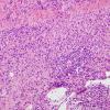 1B6 Idiopathic Hypertrophic Pachymeningitis (hyper-IgG4, Case 1) dura H&E 12