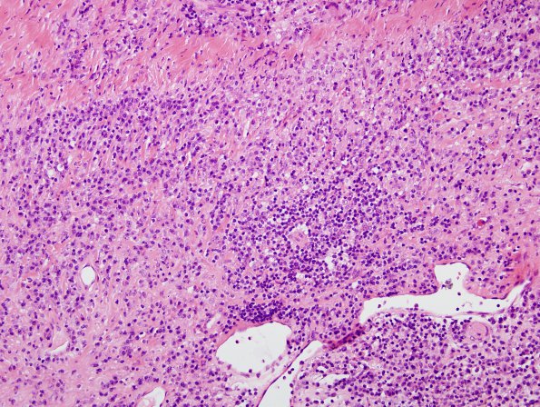 1B6 Idiopathic Hypertrophic Pachymeningitis (hyper-IgG4, Case 1) dura H&E 12