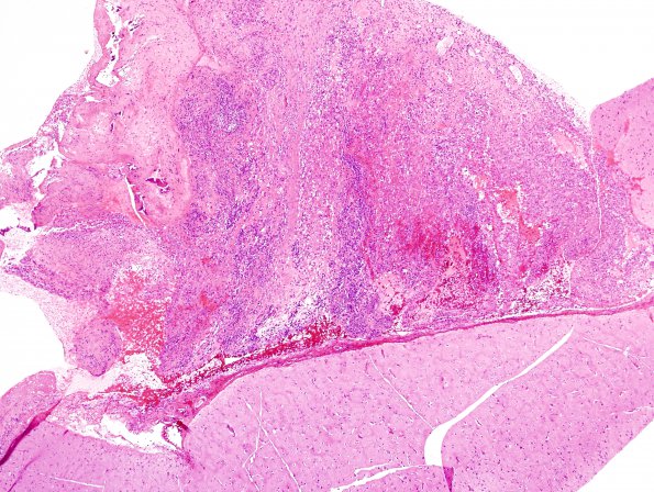 1B7 Idiopathic Hypertrophic Pachymeningitis (hyper-IgG4, Case 1) brain H&E 1