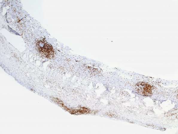 1C1 Idiopathic Hypertrophic Pachymeningitis (hyper-IgG4, Case 1) dura CD3 1