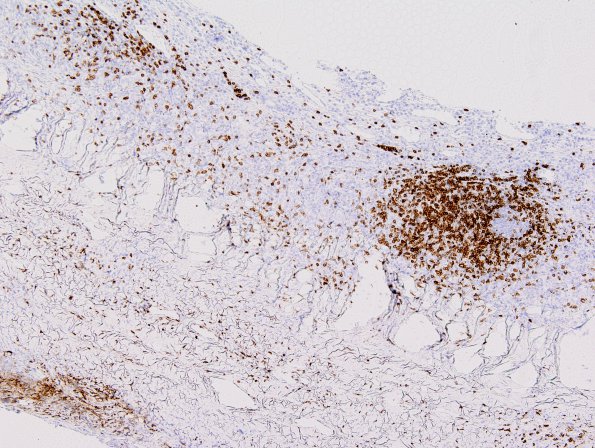 1C2 Idiopathic Hypertrophic Pachymeningitis (hyper-IgG4, Case 1) dura CD3 2