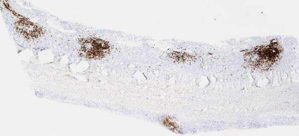 1D1 Idiopathic Hypertrophic Pachymeningitis (hyper-IgG4, Case 1) dura CD20 1