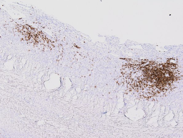 1D2 Idiopathic Hypertrophic Pachymeningitis (hyper-IgG4, Case 1) dura CD20 2