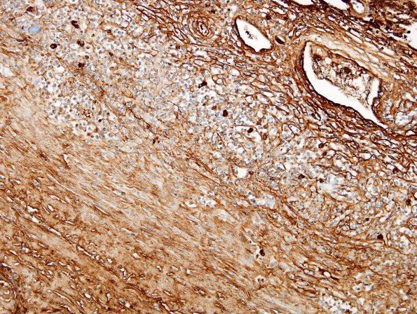 1E1 Idiopathic Hypertrophic Pachymeningitis (hyper-IgG4, Case 1) dura IgG 5