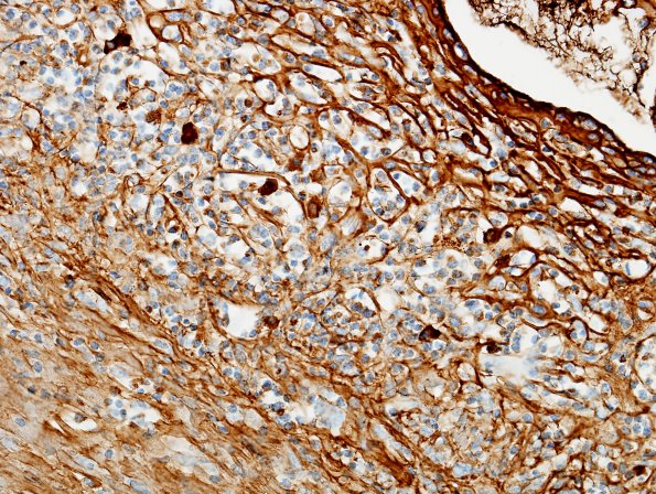 1E2 Idiopathic Hypertrophic Pachymeningitis (hyper-IgG4, Case 1) dura IgG 1