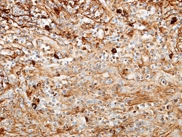 1E3 Idiopathic Hypertrophic Pachymeningitis (hyper-IgG4, Case 1) dura IgG 7