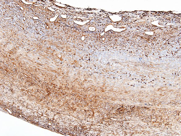 1F1 Idiopathic Hypertrophic Pachymeningitis (hyper-IgG4, Case 1) dura IgG4 2