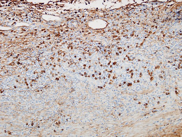 1F2 Idiopathic Hypertrophic Pachymeningitis (hyper-IgG4, Case 1) dura IgG4 1