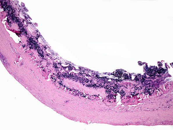 1G1 Idiopathic Hypertrophic Pachymeningitis (hyper-IgG4, Case 1) dura ISH Kappa 2