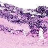 1G2 Idiopathic Hypertrophic Pachymeningitis (hyper-IgG4, Case 1) dura ISH Kappa 1