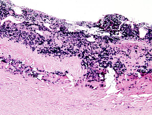 1G2 Idiopathic Hypertrophic Pachymeningitis (hyper-IgG4, Case 1) dura ISH Kappa 1