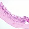 1H1 Idiopathic Hypertrophic Pachymeningitis (hyper-IgG4, Case 1) dura ISH Lambda 1