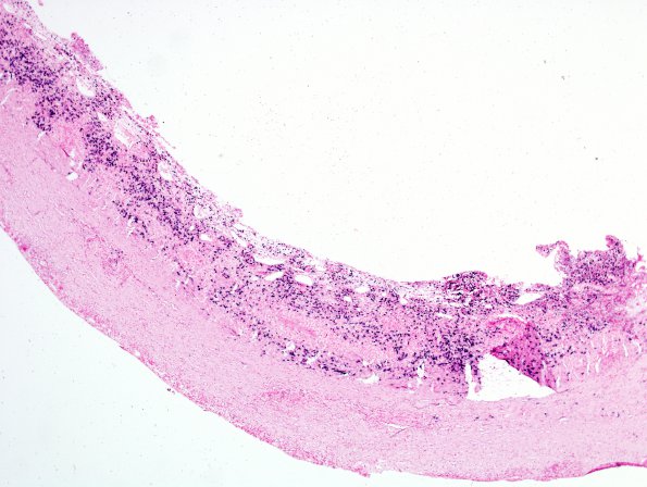 1H1 Idiopathic Hypertrophic Pachymeningitis (hyper-IgG4, Case 1) dura ISH Lambda 1