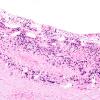 1H2 Idiopathic Hypertrophic Pachymeningitis (hyper-IgG4, Case 1) dura ISH Lambda 2