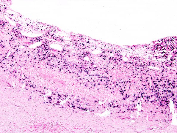 1H2 Idiopathic Hypertrophic Pachymeningitis (hyper-IgG4, Case 1) dura ISH Lambda 2