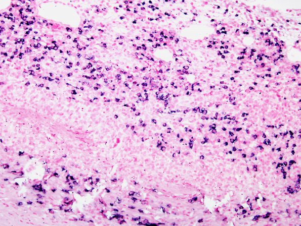 1H3 Idiopathic Hypertrophic Pachymeningitis (hyper-IgG4, Case 1) dura ISH Lambda 3