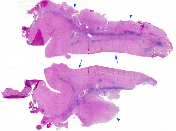 2A1 IgG4-Related Hypertrophic Pachymeningitis (Case 2) A1 H&E whole mount copy