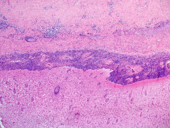 2A10 IgG4-Related Hypertrophic Pachymeningitis (Case 2) H&E 4X 2