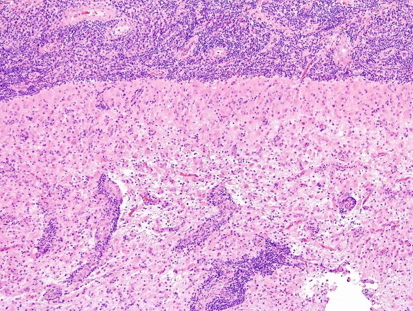 2A11 IgG4-Related Hypertrophic Pachymeningitis (Case 2) H&E 10X 3