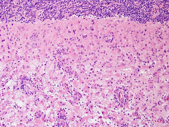 2A12 IgG4-Related Hypertrophic Pachymeningitis (Case 2) H&E 18