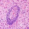 2A13 IgG4-Related Hypertrophic Pachymeningitis (Case 2) H&E 19