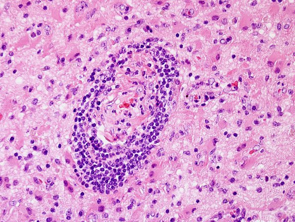 2A13 IgG4-Related Hypertrophic Pachymeningitis (Case 2) H&E 19