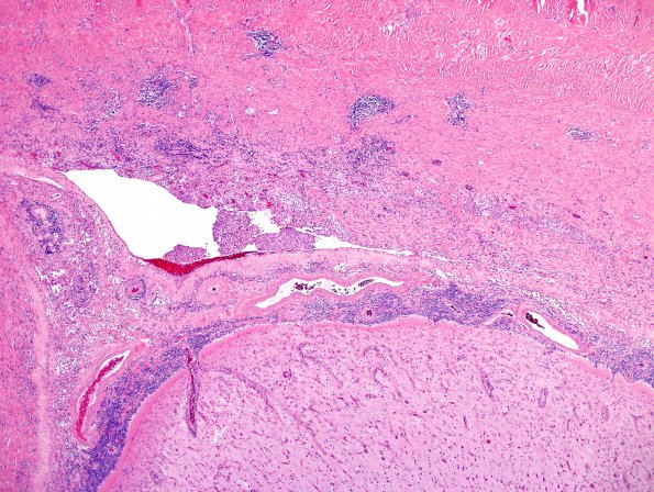 2A2 IgG4-Related Hypertrophic Pachymeningitis (Case 2) H&E 27