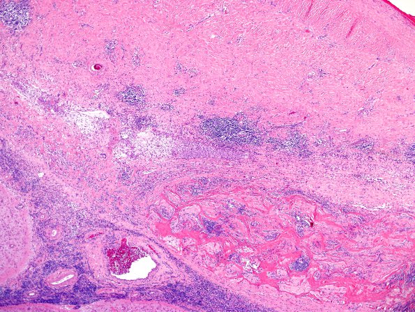 2A3 IgG4-Related Hypertrophic Pachymeningitis (Case 2) H&E 28