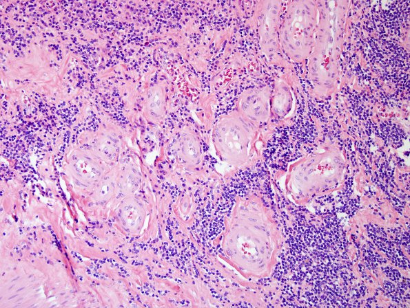 2A4 IgG4-Related Hypertrophic Pachymeningitis (Case 2) H&E 4