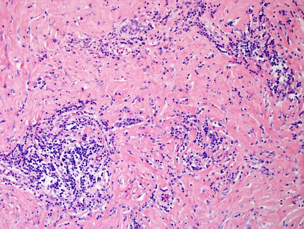 2A5 IgG4-Related Hypertrophic Pachymeningitis (Case 2) H&E 7